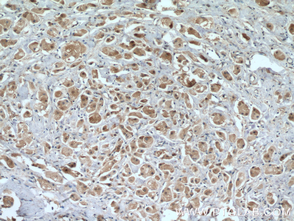IHC staining of human breast cancer using 18436-1-AP