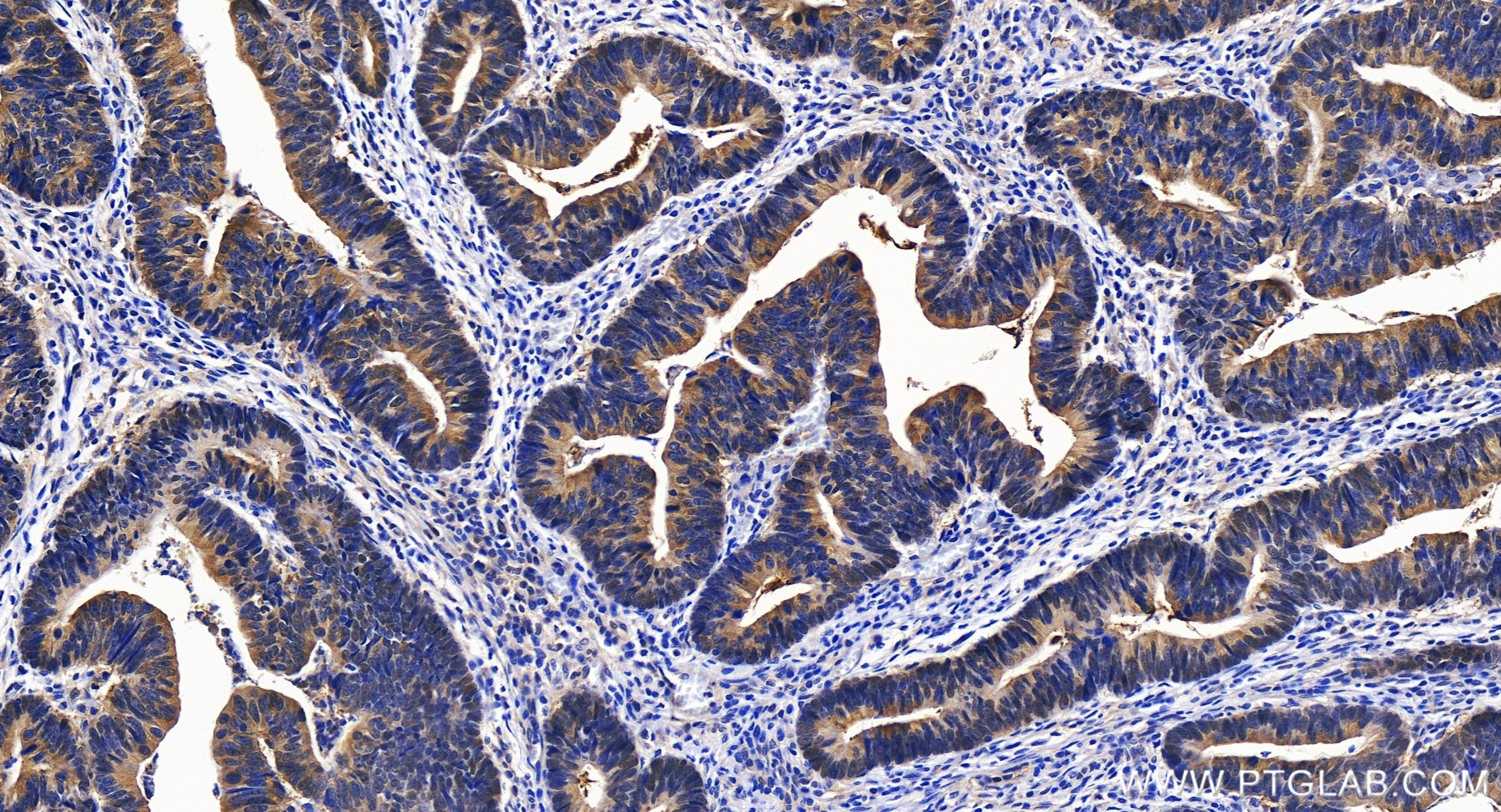 IHC staining of human colon cancer using 82750-2-RR
