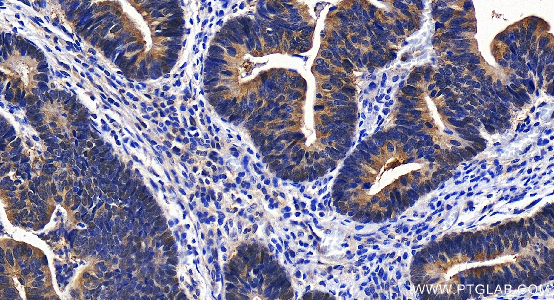 IHC staining of human colon cancer using 82750-2-RR