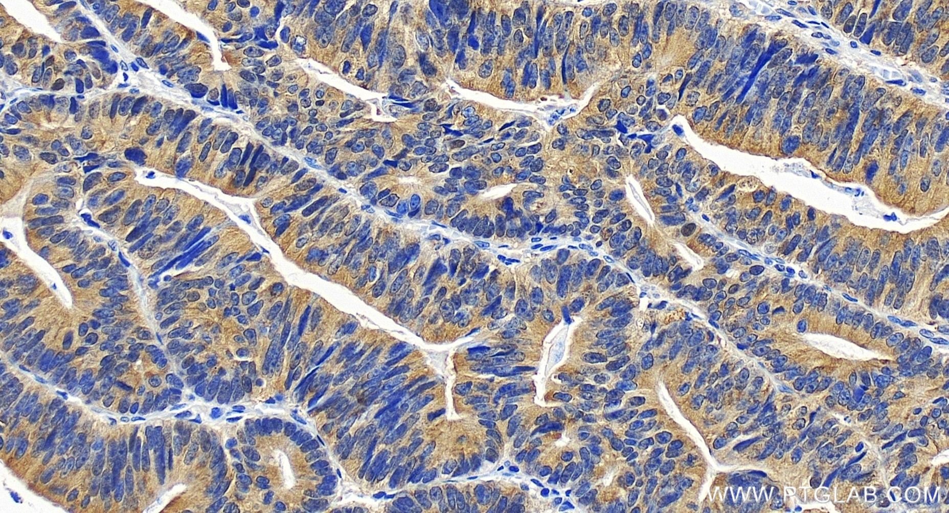 Immunohistochemical analysis of paraffin-embedded human colon cancer tissue slide using 82750-3-RR (PRMT5 antibody) at dilution of 1:400 (under 20x lens). Heat mediated antigen retrieval with Tris-EDTA buffer (pH 9.0). IHC staining of human colon cancer using 82750-3-RR