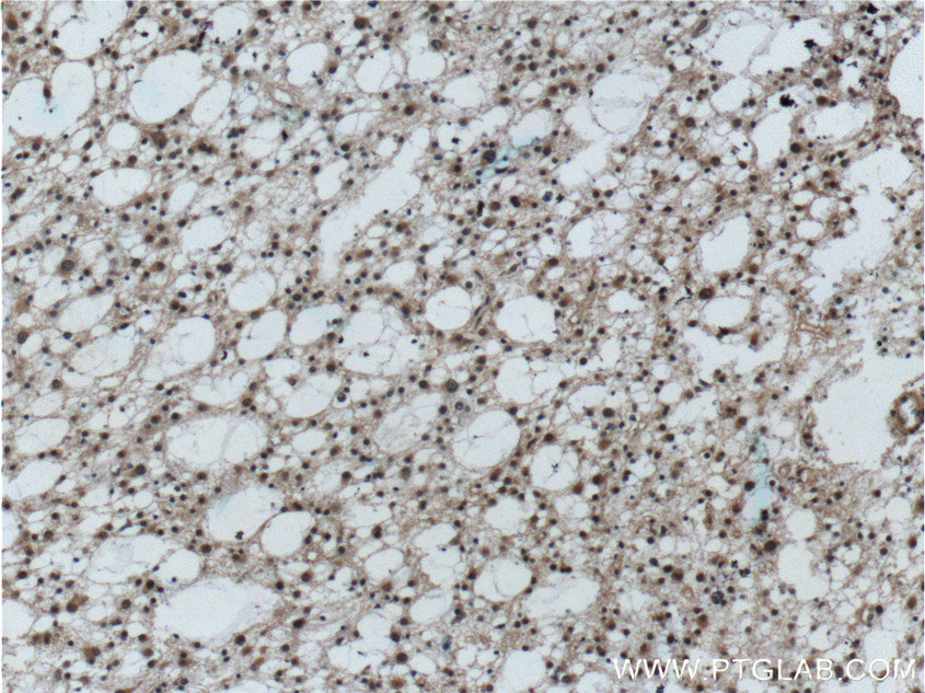 IHC staining of human gliomas using 12555-1-AP (same clone as 12555-1-PBS)