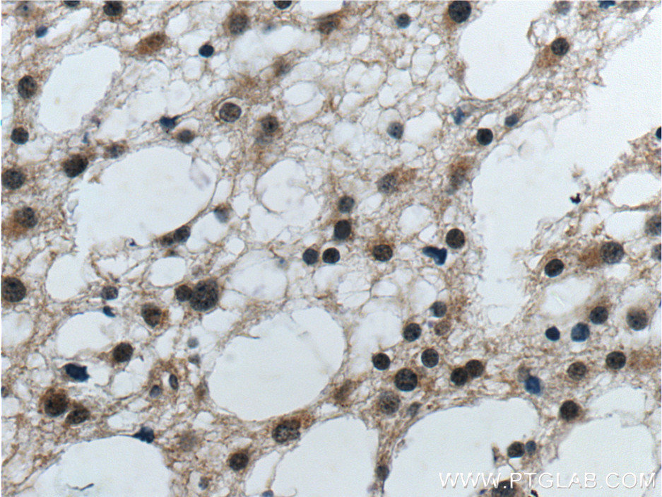 IHC staining of human gliomas using 12555-1-AP