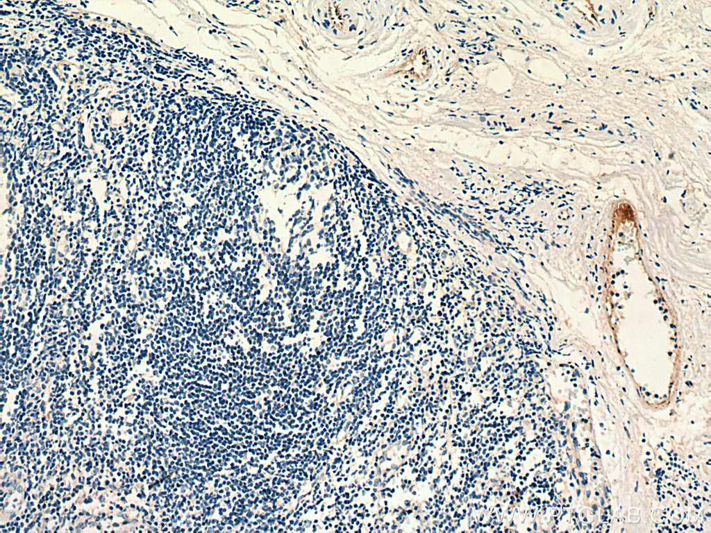 IHC staining of human tonsillitis using 67658-1-Ig