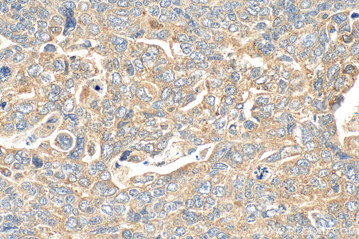 IHC staining of human ovary tumor using 31494-1-AP (same clone as 31494-1-PBS) IHC staining of human ovary tumor using 31494-1-AP (same clone as 31494-1-PBS)