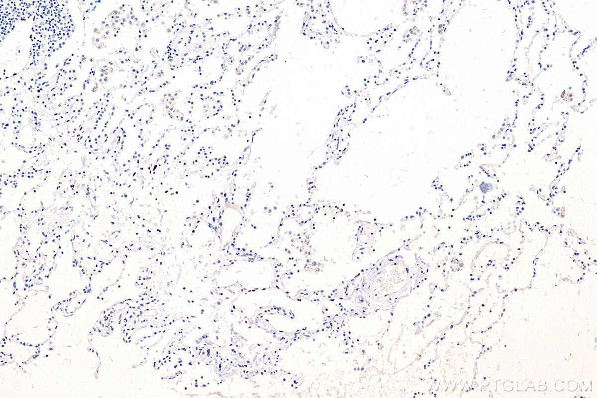 IHC staining of human lung cancer using 67438-1-Ig