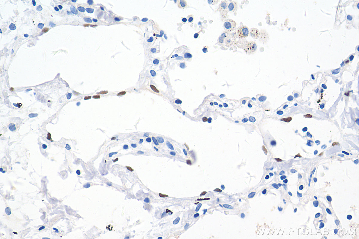 IHC staining of human lung cancer using 67438-1-Ig (same clone as 67438-1-PBS)