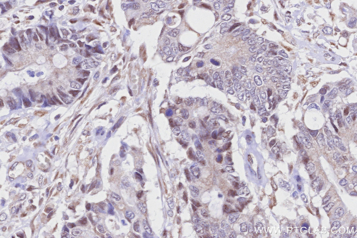 IHC staining of human rectal cancer using 81778-1-RR IHC staining of human rectal cancer using 81778-1-RR