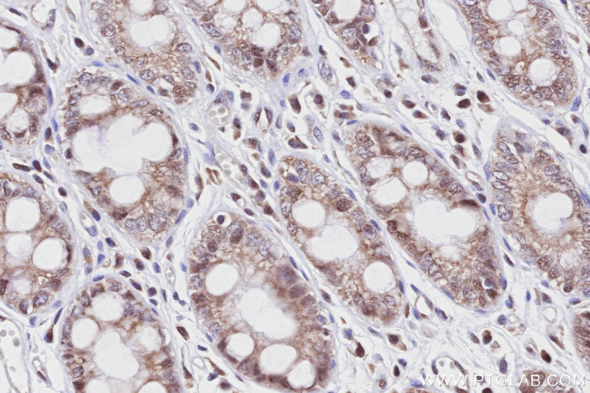 IHC staining of human rectal cancer using 81778-1-RR IHC staining of human rectal cancer using 81778-1-RR