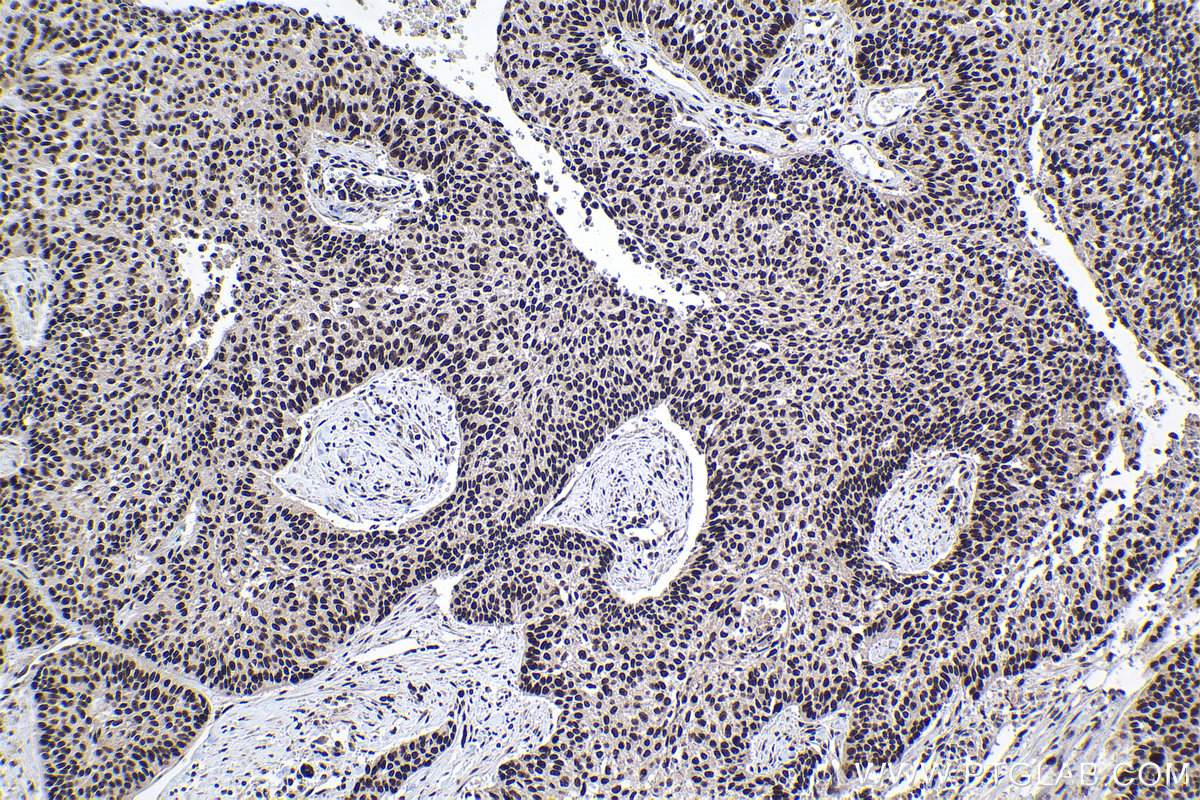Immunohistochemical analysis of paraffin-embedded human lung cancer tissue slide using 17392-1-AP (PRPF40A antibody) at dilution of 1:500 (under 10x lens). Heat mediated antigen retrieval with Tris-EDTA buffer (pH 9.0). IHC staining of human lung cancer using 17392-1-AP