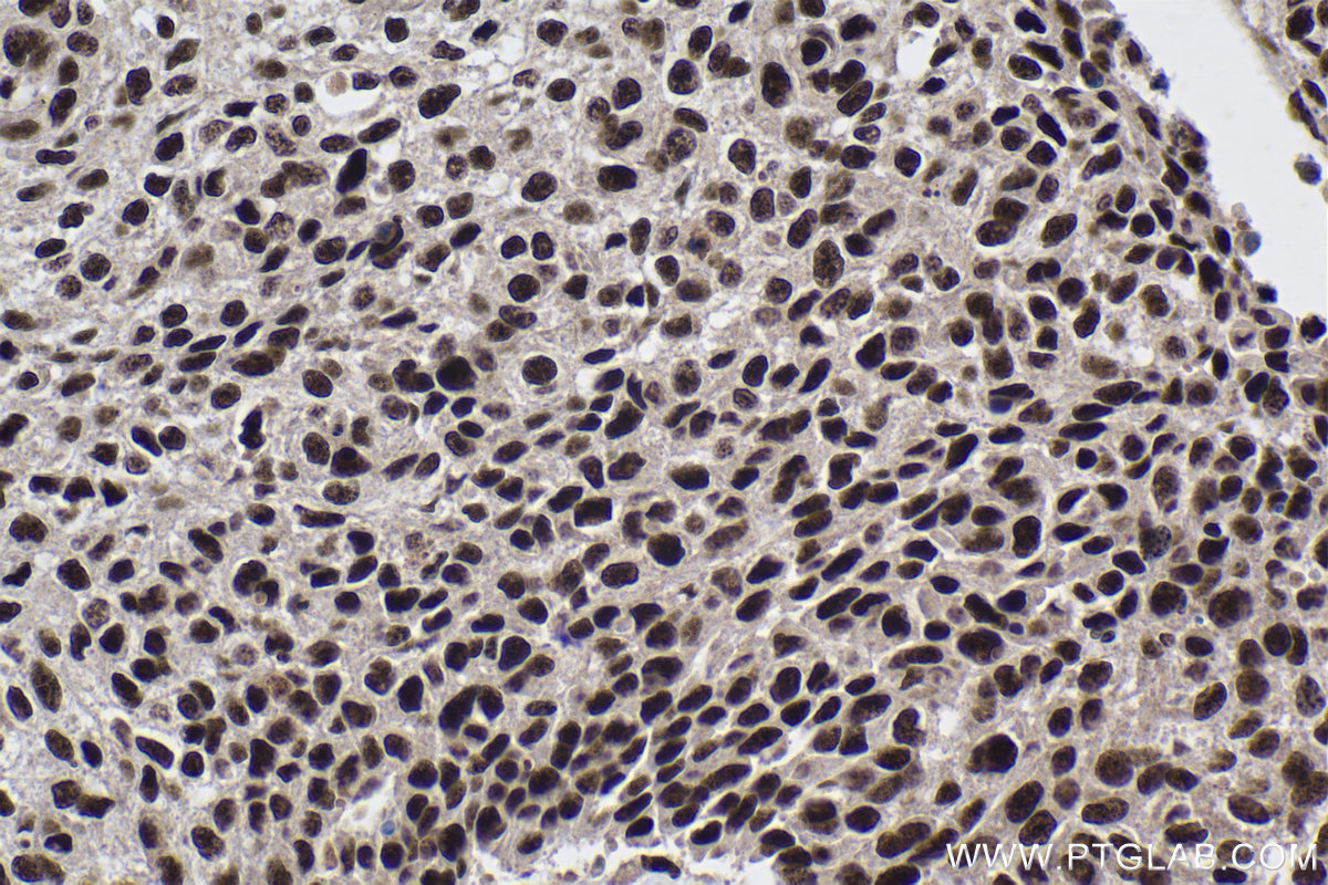 Immunohistochemical analysis of paraffin-embedded human lung cancer tissue slide using 17392-1-AP (PRPF40A antibody) at dilution of 1:500 (under 40x lens). Heat mediated antigen retrieval with Tris-EDTA buffer (pH 9.0). IHC staining of human lung cancer using 17392-1-AP