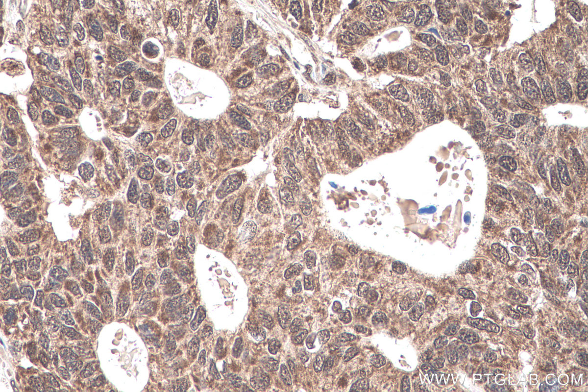 IHC staining of human stomach cancer using 11171-1-AP (same clone as 11171-1-PBS)