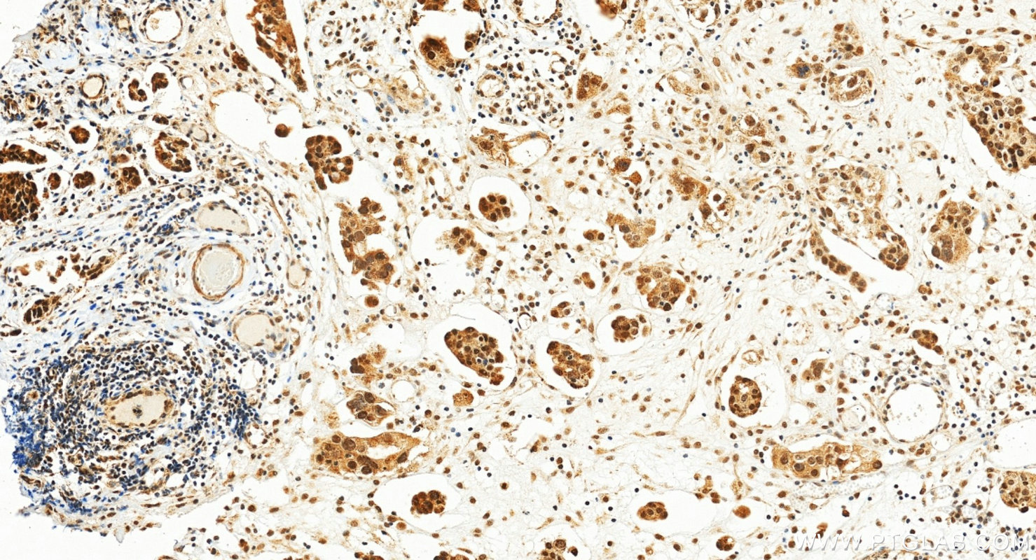 IHC staining of human ovary tumor using 11171-1-AP IHC staining of human ovary tumor using 11171-1-AP