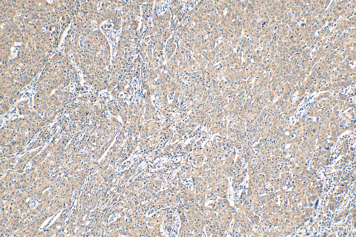 IHC staining of human cervical cancer using 16790-1-AP