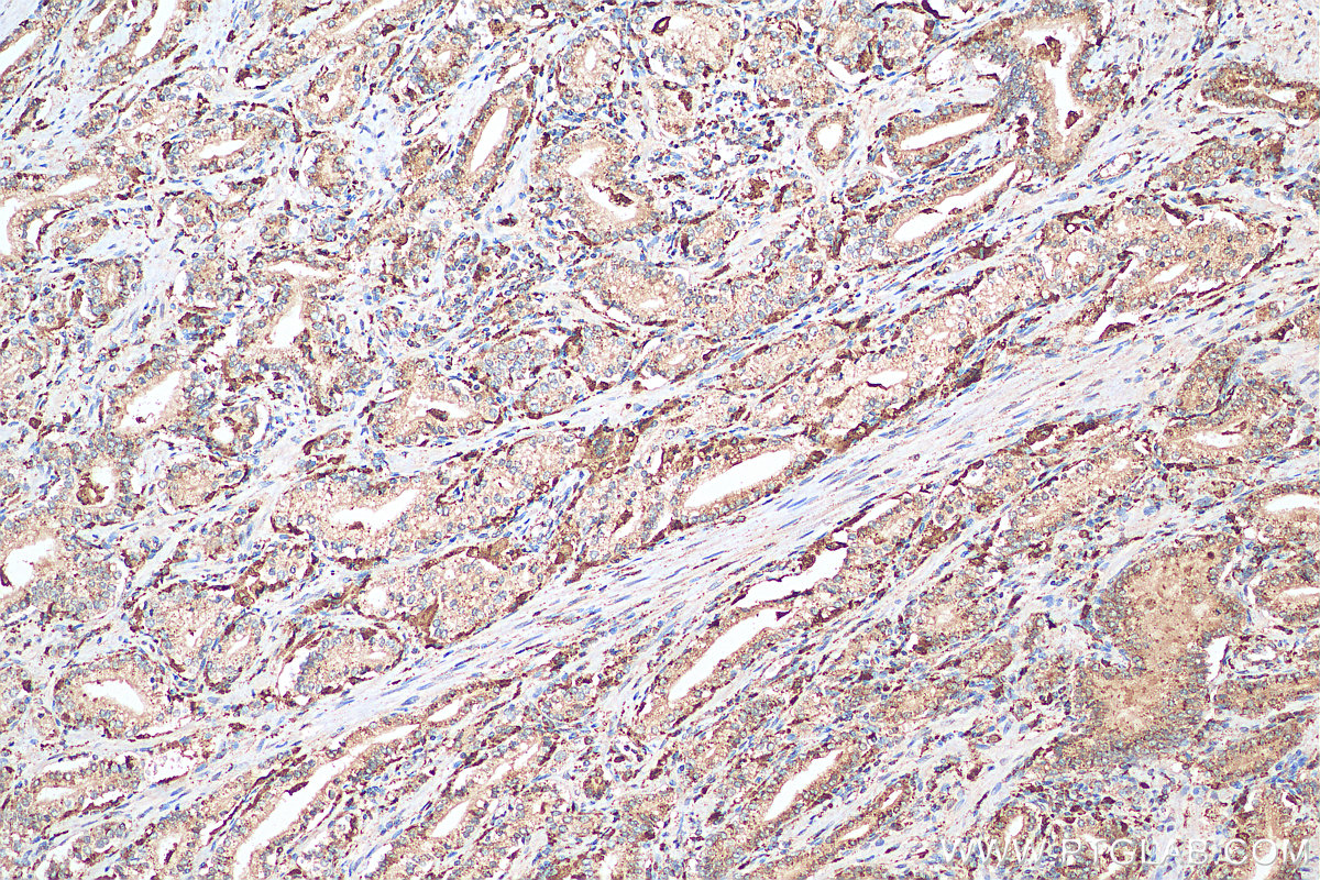 IHC staining of human prostate cancer using 18397-1-AP