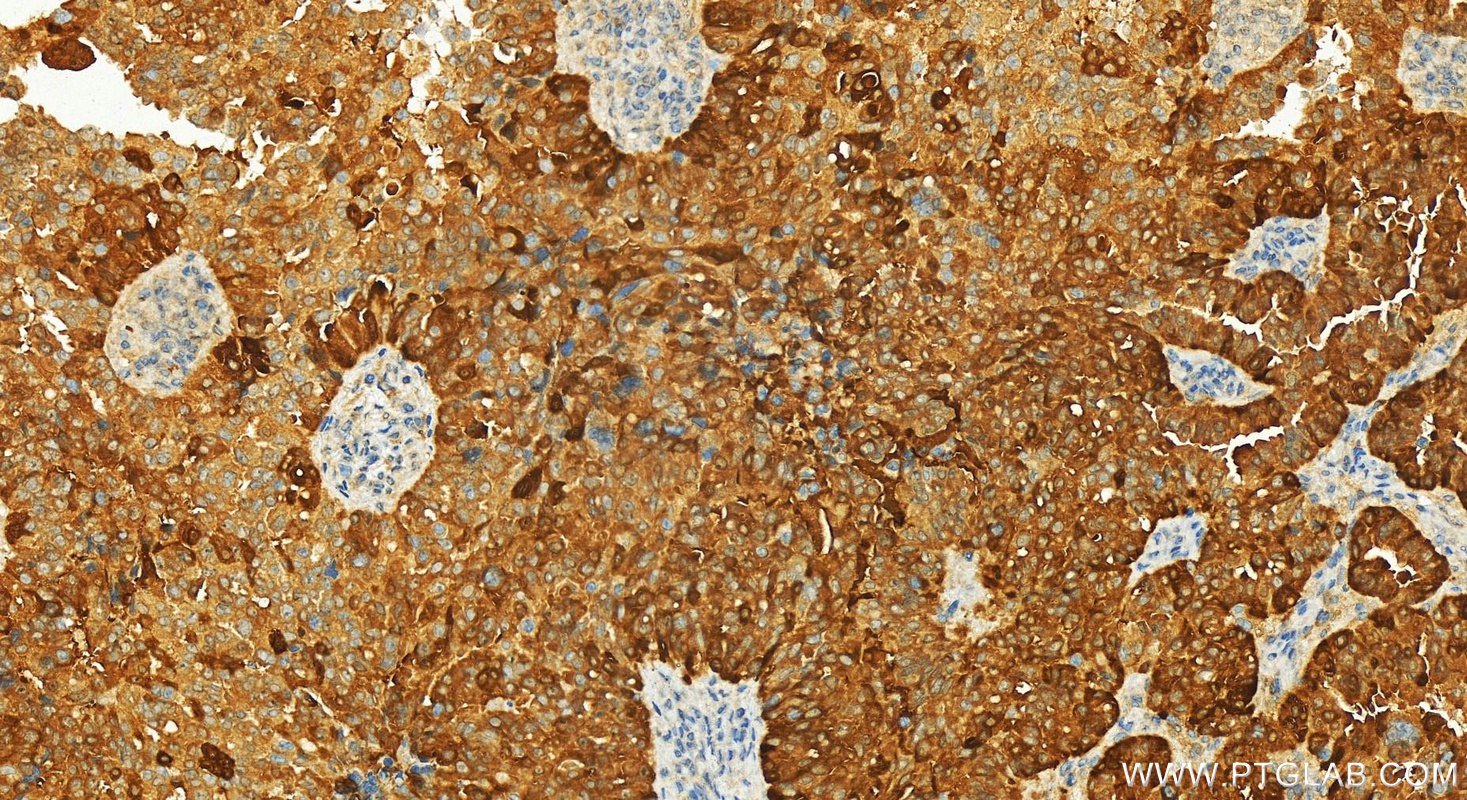 Immunohistochemical analysis of paraffin-embedded human ovarian cancer slide using 81479-1-RR (PSAT1 antibody) at dilution of 1:600 (under 20x lens). Heat mediated antigen retrieval with Tris-EDTA buffer (pH 9.0). IHC staining of human ovarian cancer using 81479-1-RR