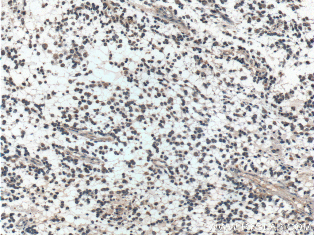 IHC staining of human gliomas using 20434-1-AP