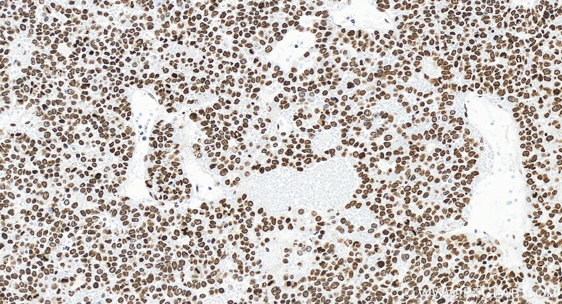 IHC staining of human liver cancer using 85395-1-RR