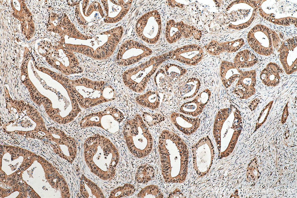 IHC staining of human colon cancer using 67910-1-Ig (same clone as 67910-1-PBS)