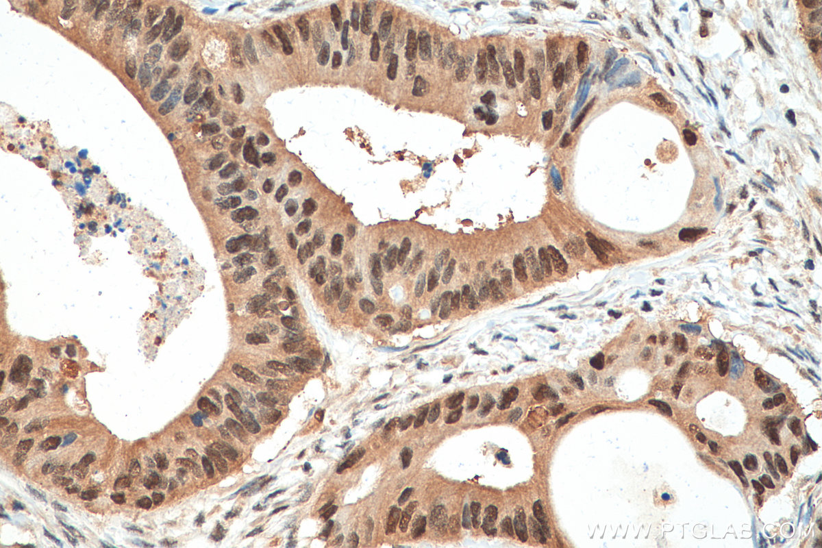 IHC staining of human colon cancer using 67910-1-Ig (same clone as 67910-1-PBS)