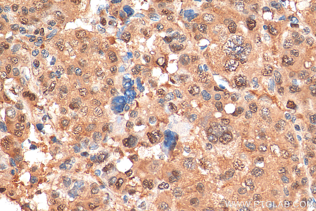 IHC staining of human liver cancer using 67938-1-Ig