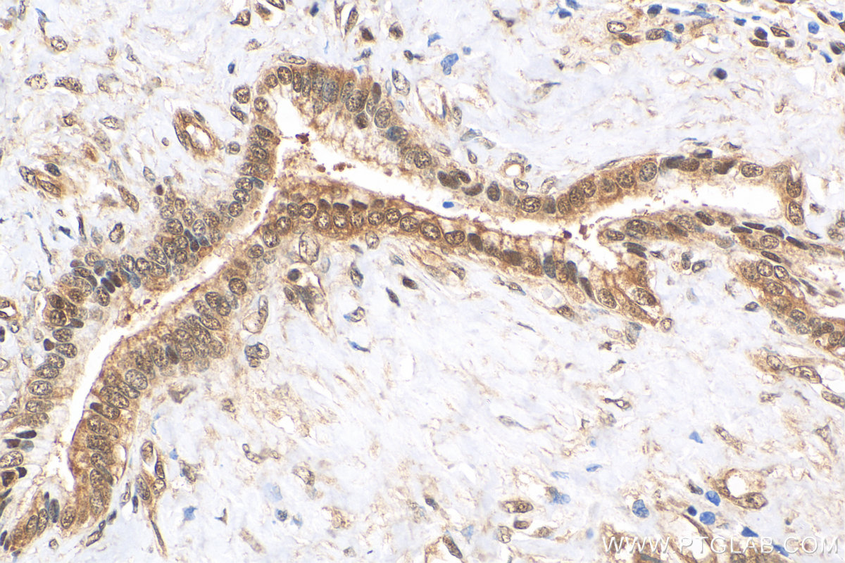 IHC staining of human pancreas cancer using 68203-1-Ig