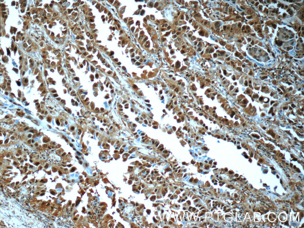 IHC staining of human lung cancer using 11573-1-AP