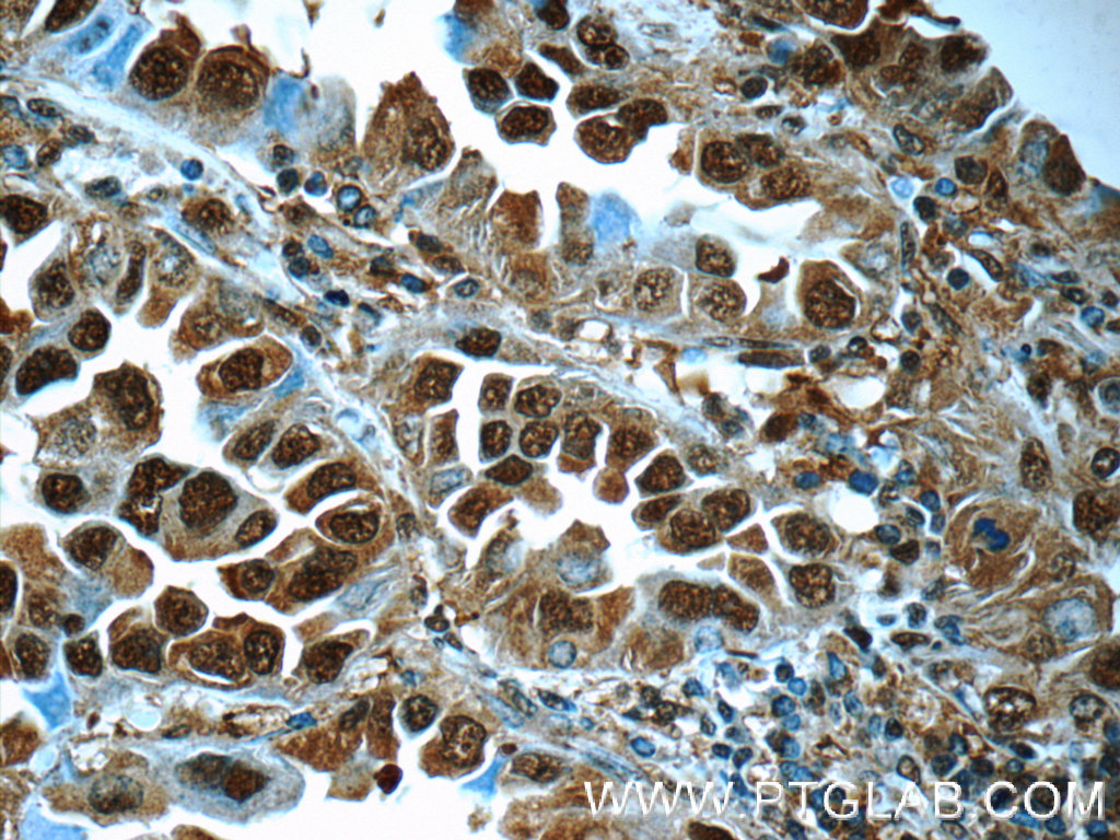 IHC staining of human lung cancer using 11573-1-AP