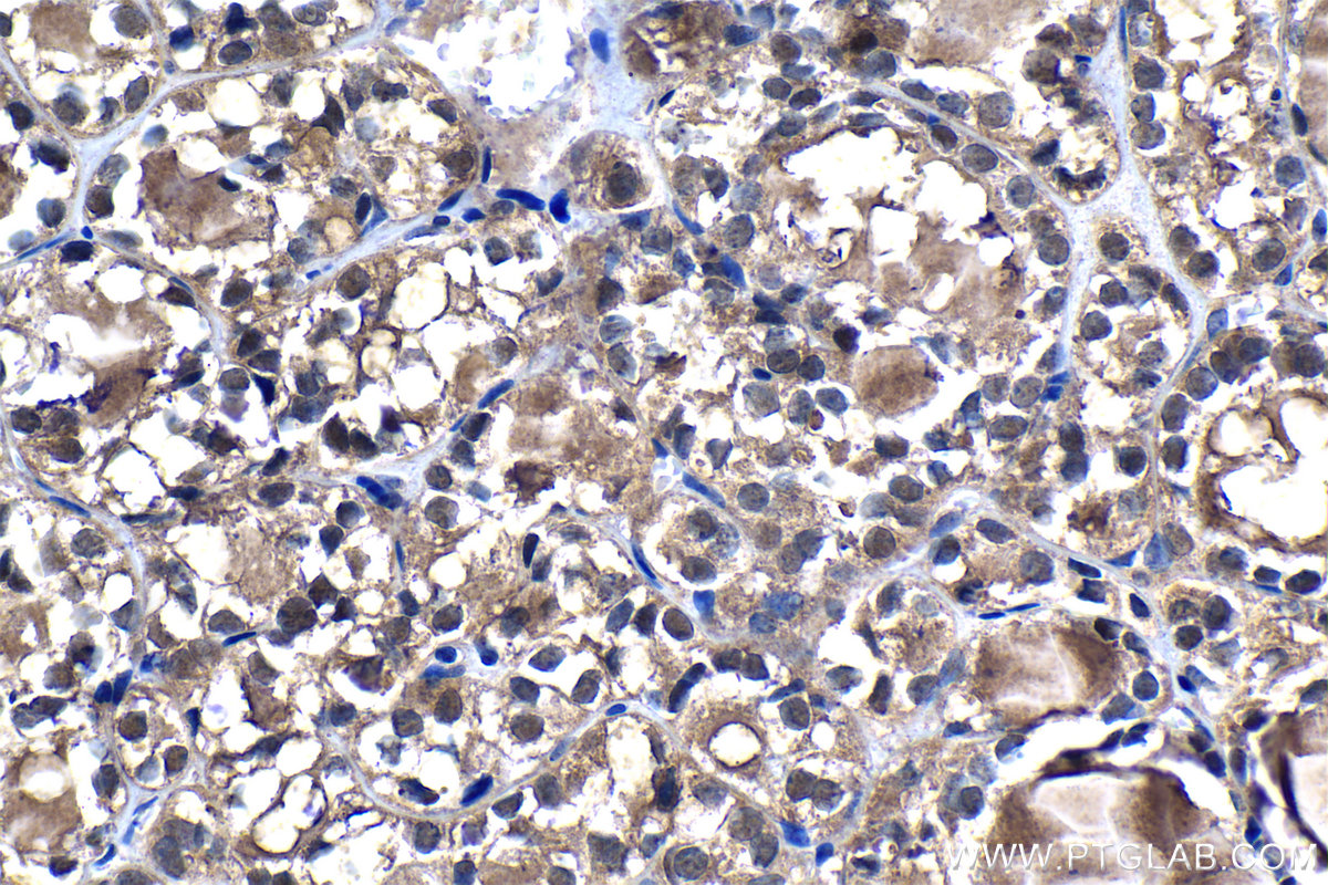 IHC staining of human thyroid cancer using 19178-1-AP IHC staining of human thyroid cancer using 19178-1-AP