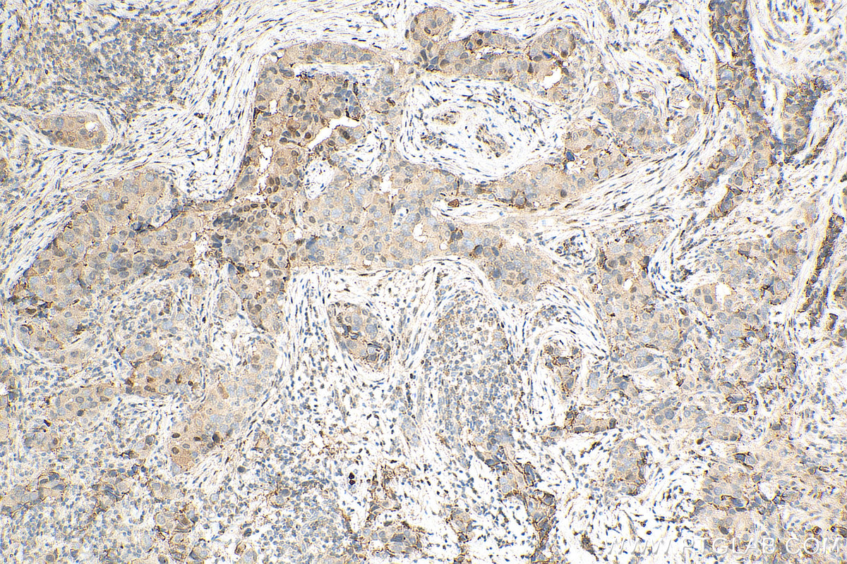 IHC staining of human breast cancer using 67959-1-Ig (same clone as 67959-1-PBS)