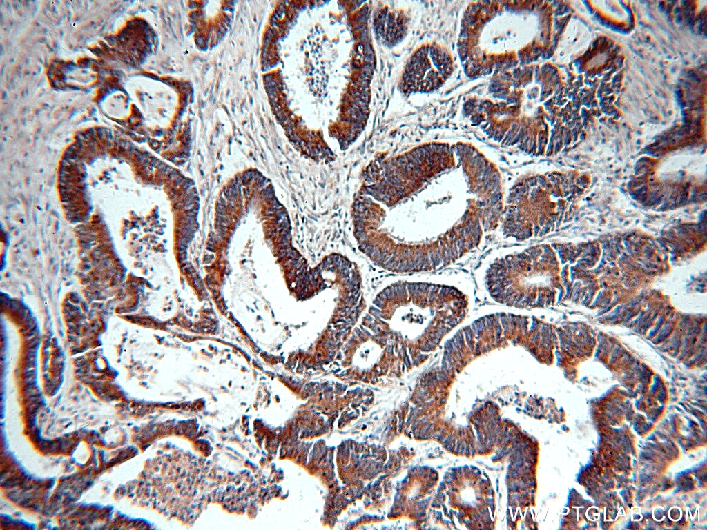 IHC staining of human colon cancer using 14727-1-AP