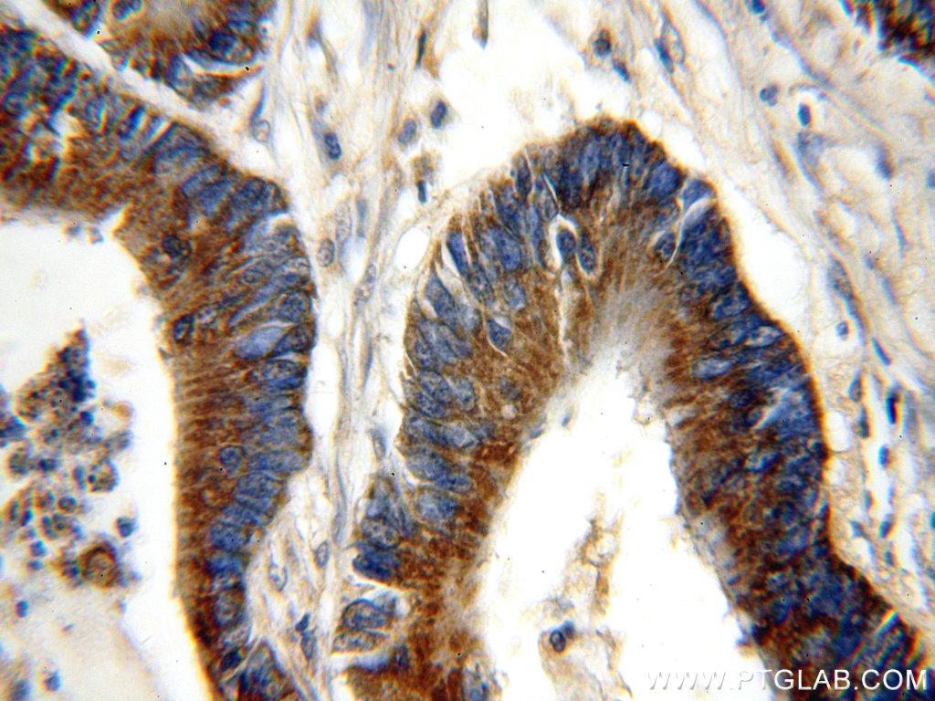 IHC staining of human colon cancer using 14727-1-AP