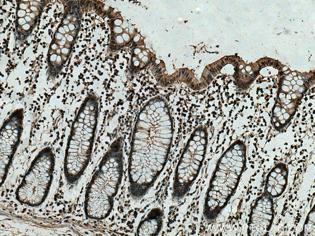 IHC staining of human colon cancer using 67748-1-Ig (same clone as 67748-1-PBS)