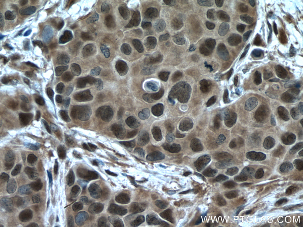 IHC staining of human breast cancer using 14905-1-AP