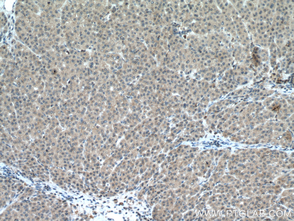 IHC staining of human liver cancer using 14752-1-AP