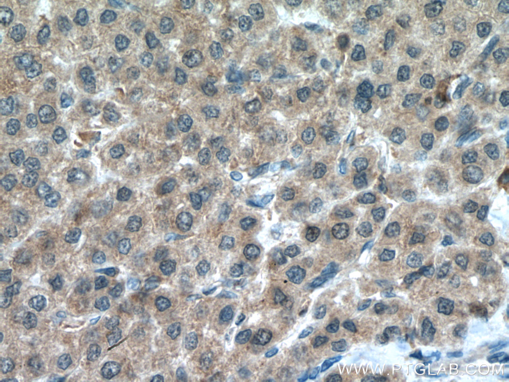 IHC staining of human liver cancer using 14752-1-AP