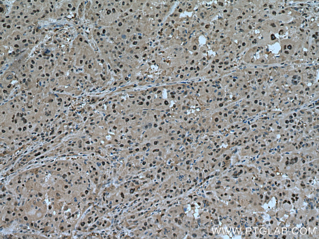 IHC staining of human liver cancer using 15839-1-AP