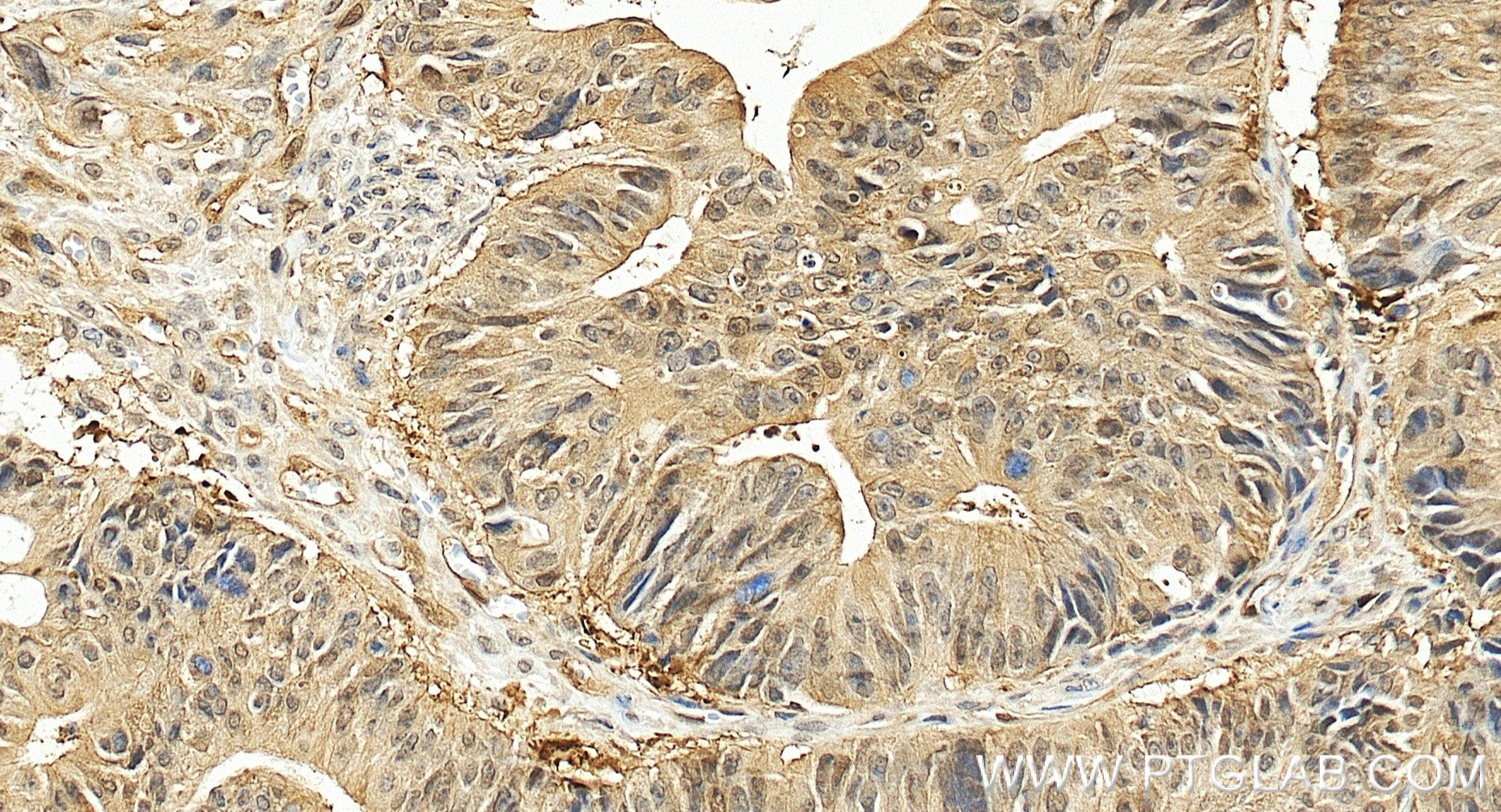IHC staining of human colon cancer using 86120-2-RR
