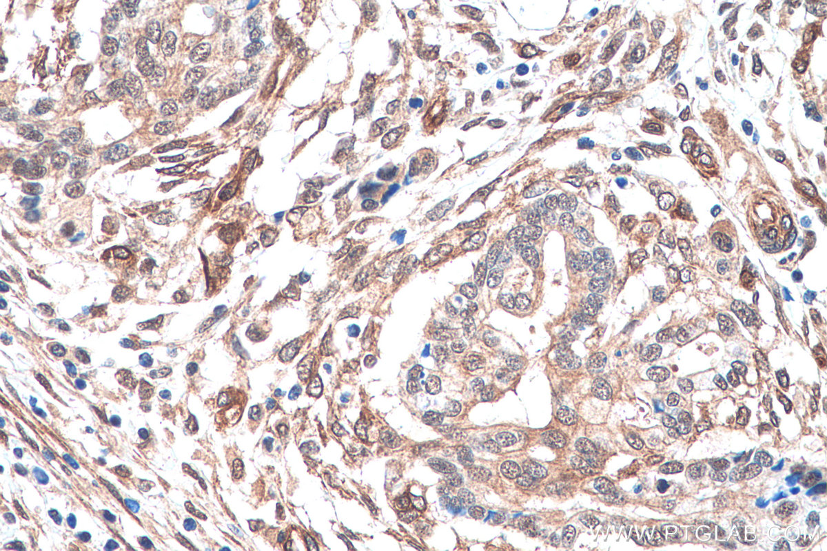 IHC staining of human pancreas cancer using 67807-1-Ig