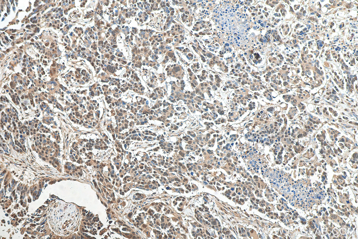 IHC staining of human colon cancer using 12054-1-AP