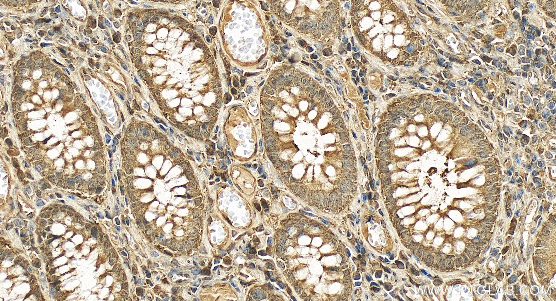 IHC staining of human colon cancer using 84928-2-RR (same clone as 84928-2-PBS)
