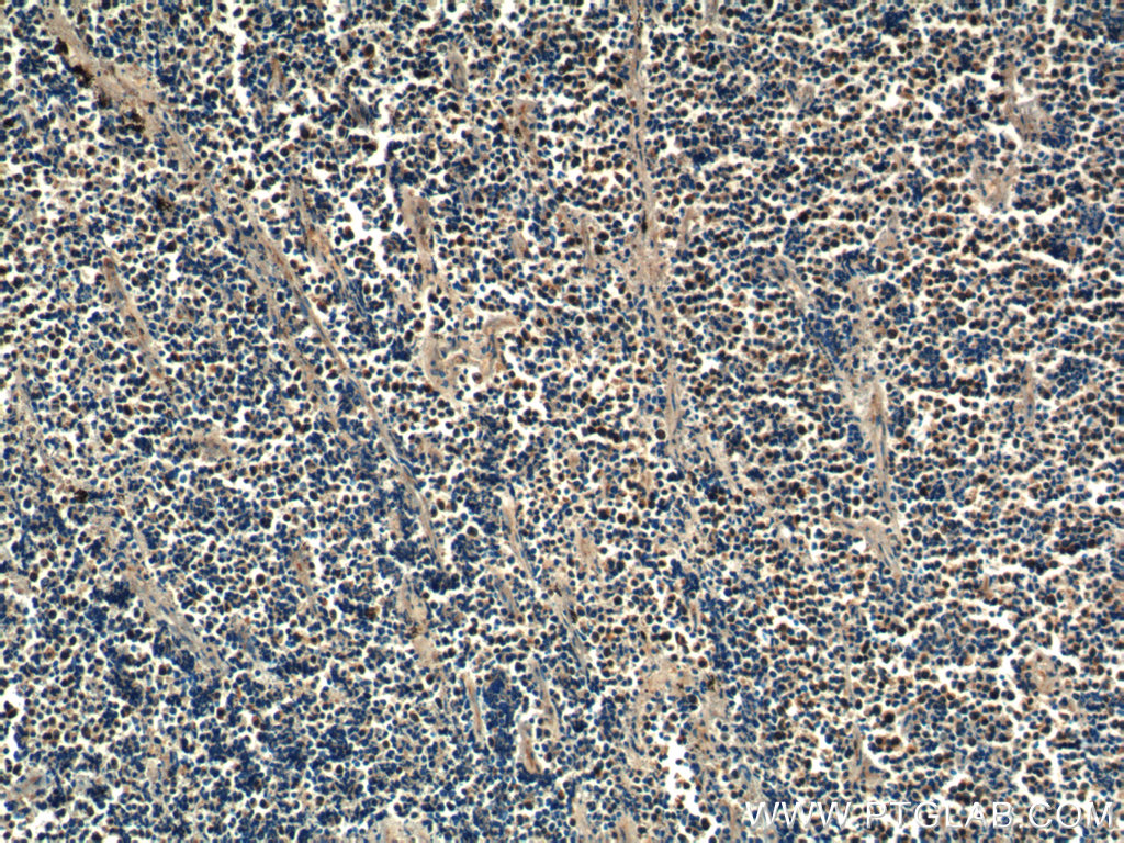 IHC staining of human lung cancer using 14899-1-AP