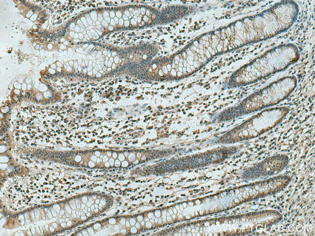 IHC staining of human colon cancer using 67682-1-Ig (same clone as 67682-1-PBS)