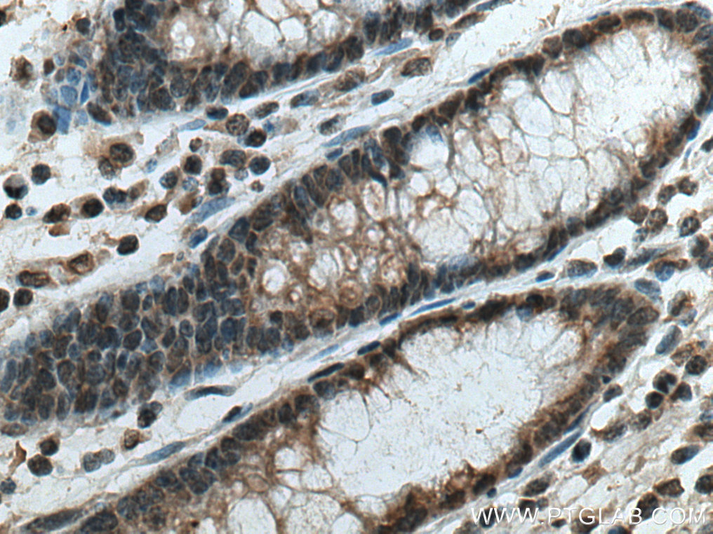 IHC staining of human colon cancer using 67682-1-Ig