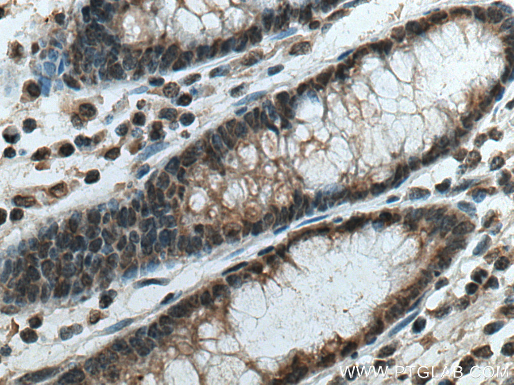 IHC staining of human colon cancer using 67682-1-Ig (same clone as 67682-1-PBS)