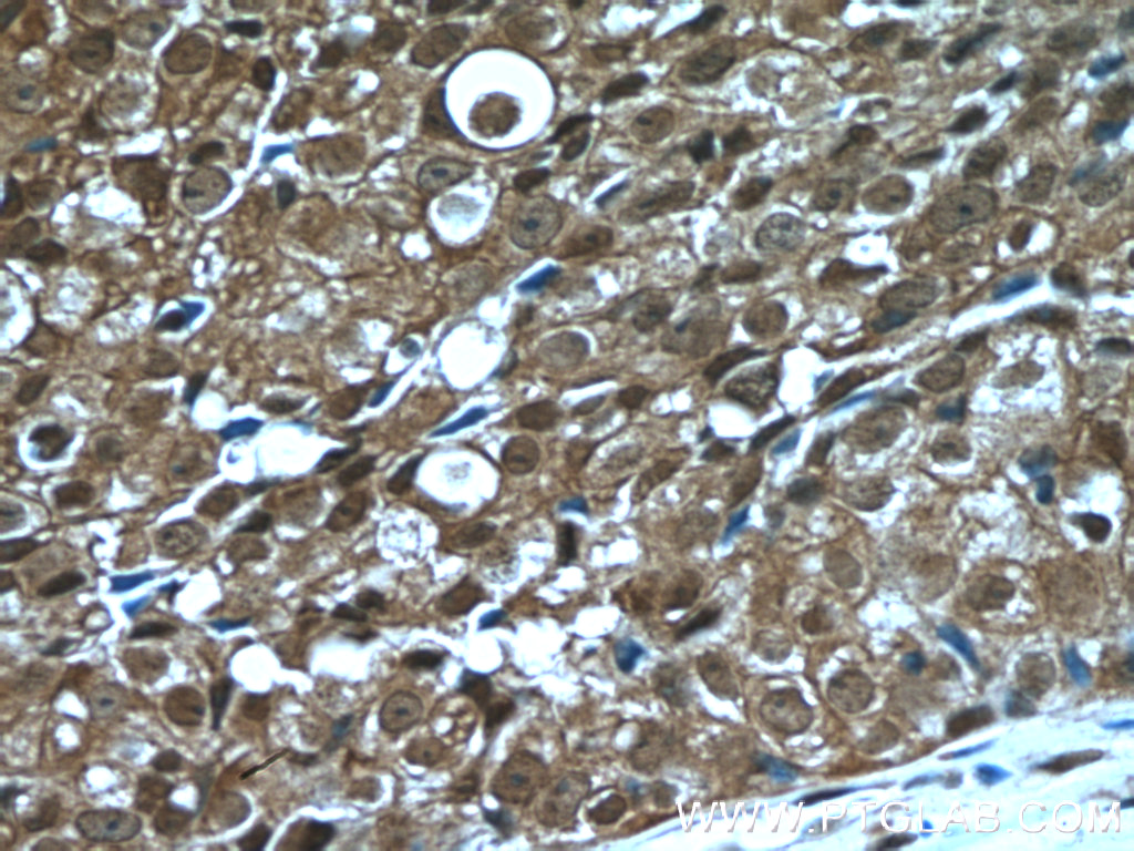 IHC staining of human breast cancer using 26922-1-AP