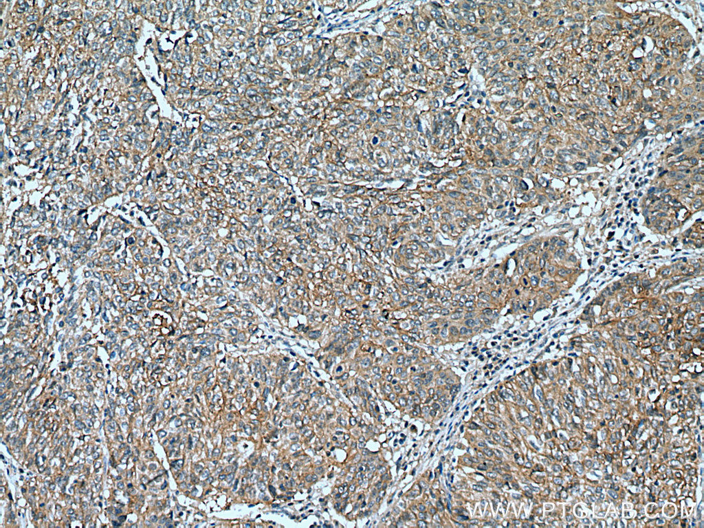 IHC staining of human cervical cancer using 67338-1-Ig