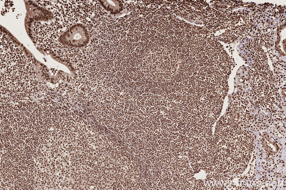 IHC staining of human appendicitis using 16714-1-AP
