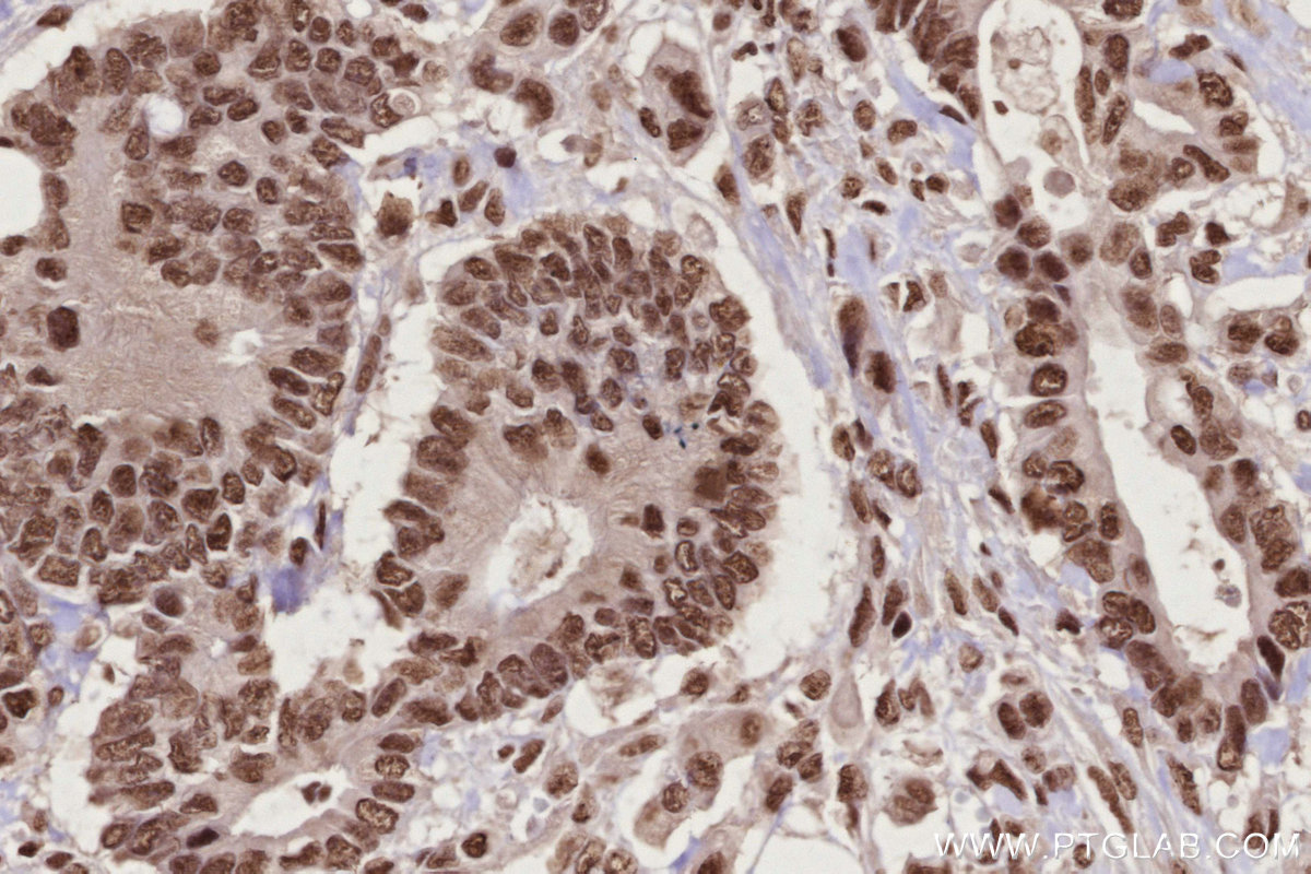 IHC staining of human rectal cancer using 16714-1-AP