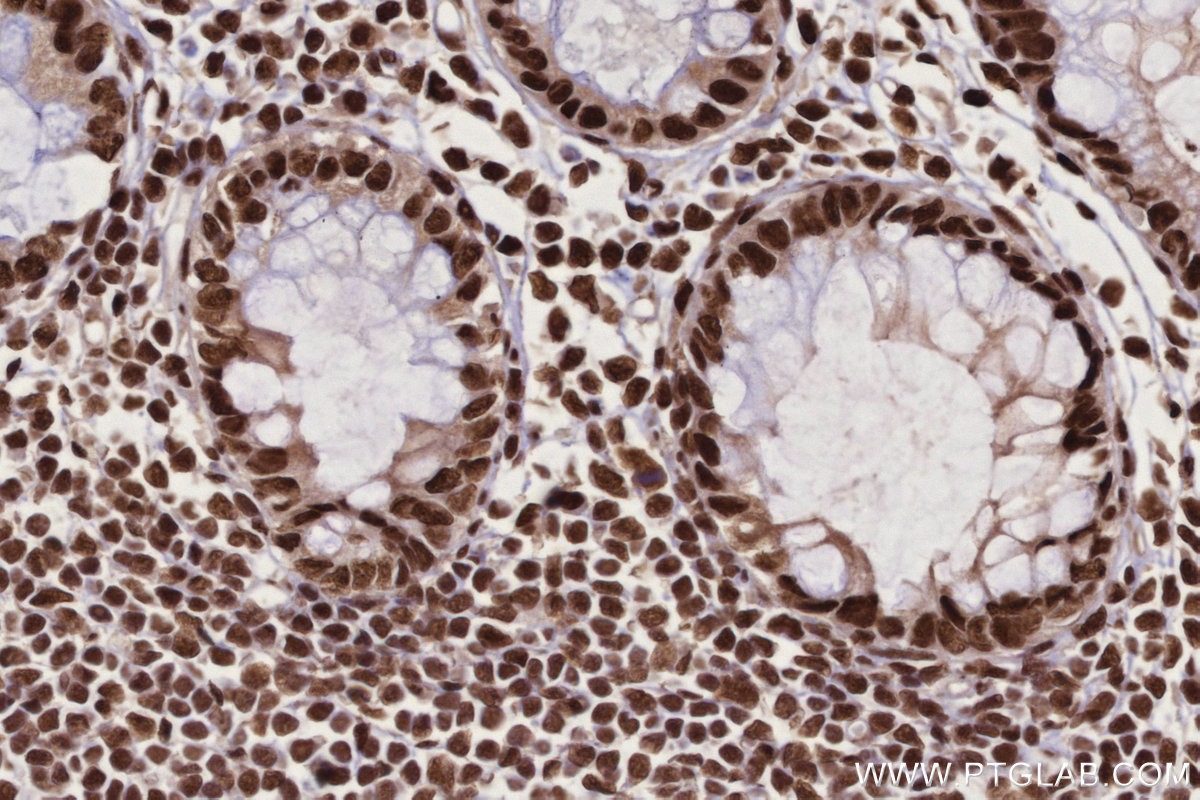 IHC staining of human rectal cancer using 16714-1-AP