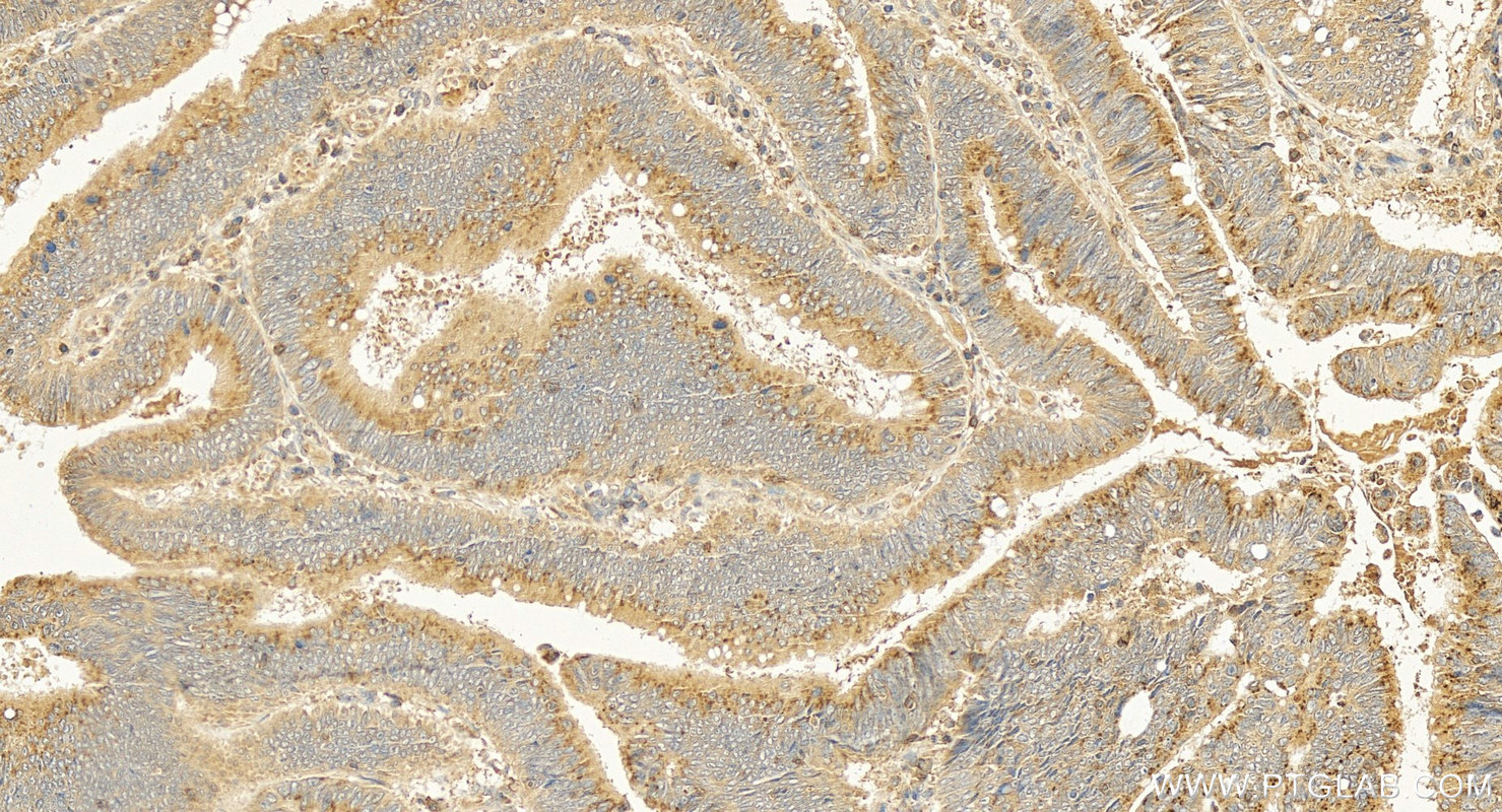 IHC staining of human colon cancer using 19713-1-AP